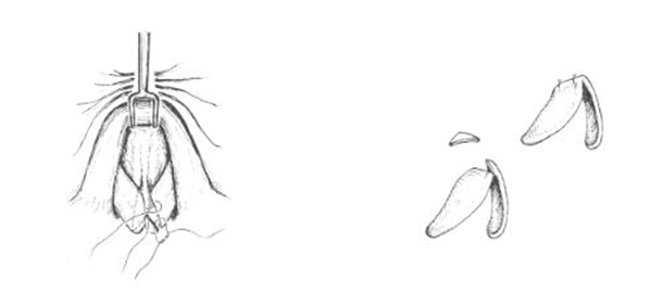 Excising a small cephalic wedge of cartilage from the dome can help reposition the cephalic margin lower