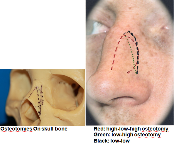 OsteotomiesAlar Base Narrowing

