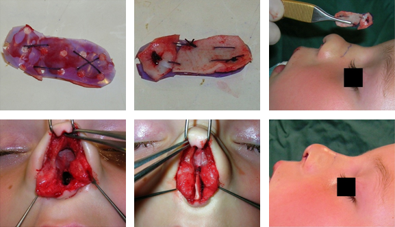 Preoperative pictures from a three-year-old girl with complete destruction of the cartilaginous nasal septum