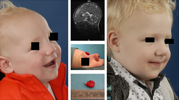 preoperative picture from a young boy with a dermoid cyst located in the nasofrontal angle