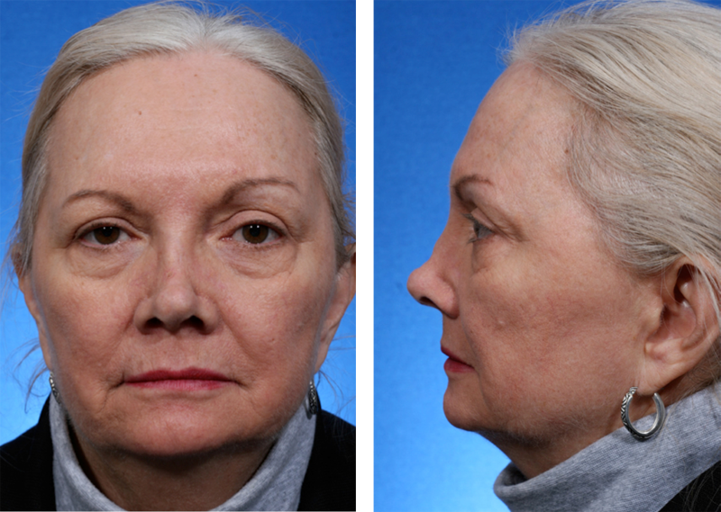 rhinoplasty where rib cartilage was chosen as the grafting material