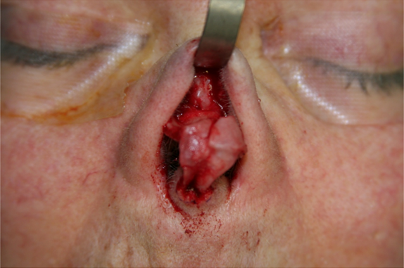 An external rhinoplasty approach was performed in order to expose the underlying nasal framework