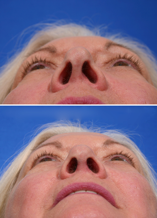 Improvement in the nasal base is noted with reduced collapse of the lower lateral cartilage