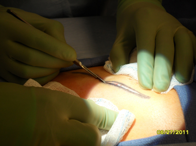 Figure 1 An incision is made through the skin overlying the 6th rib using a 15 blade scalpel.