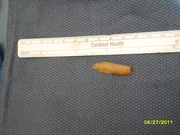 Figure 10 a A dorsal onlay graft carved from the central core of the harvested rib cartilage.  The cartilage was slowly carved to anticipate warping.