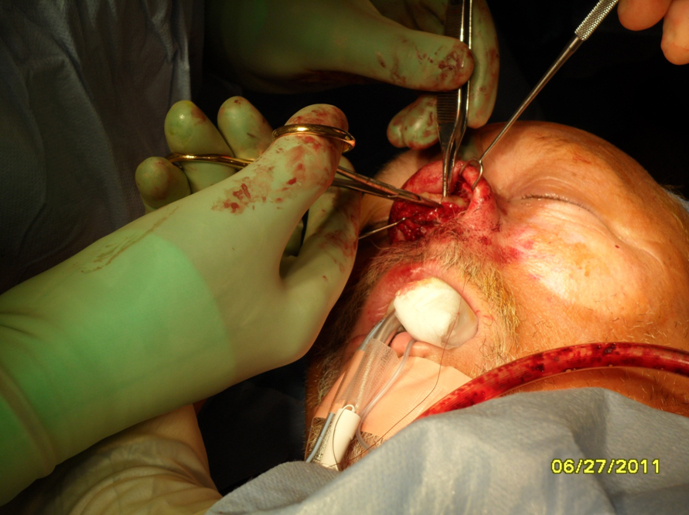 Figure 11 Placement of a dorsal onlay graft via an external rhinoplasty approach in a patient with saddle nose deformity following nasal trauma.  A notch was carved into the caudal end of the onlay graft to interdigitate with a columellar strut graft that was placed later.