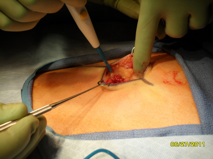 Figure 2 Electrocautery is used to divide the soft tissue down to the level of the perichondrium.