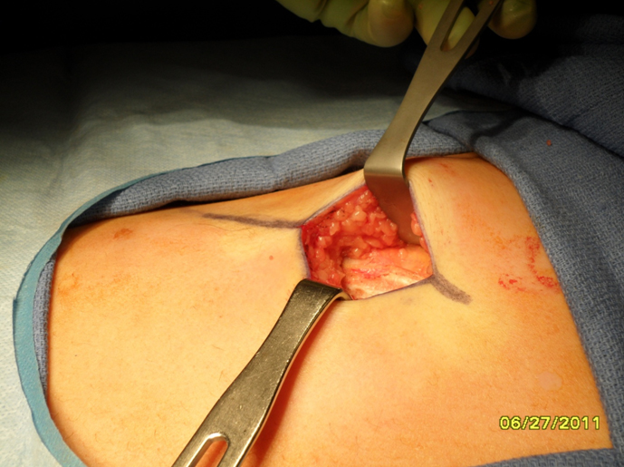 Figure 3 The subcutaneous tissue is retracted superiorly and inferiorly to expose the underlying rib.