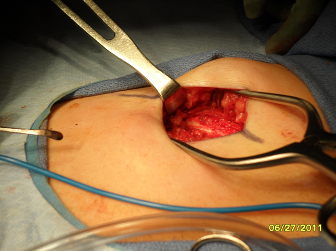 Figure 4 A self-retaining retractor is placed into the wound to aid with exposure of the underlying rib.  An Army Navy retractor is used to expose the costochondral junctions medially and laterally.