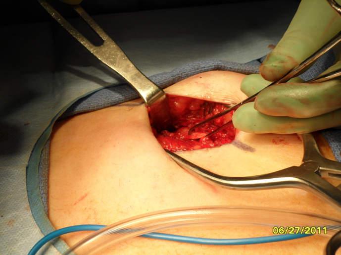 Figure 5 The anterior perichondrium has been bluntly dissected free from the underlying rib.