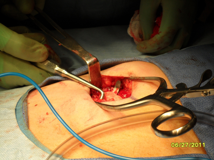 Figure 6 Once the anterior perichondrium has been dissected free, a rib stripper is used to separate the rib from the posterior perichondrium.  Care is taken to avoid violating the underlying parietal pleura.