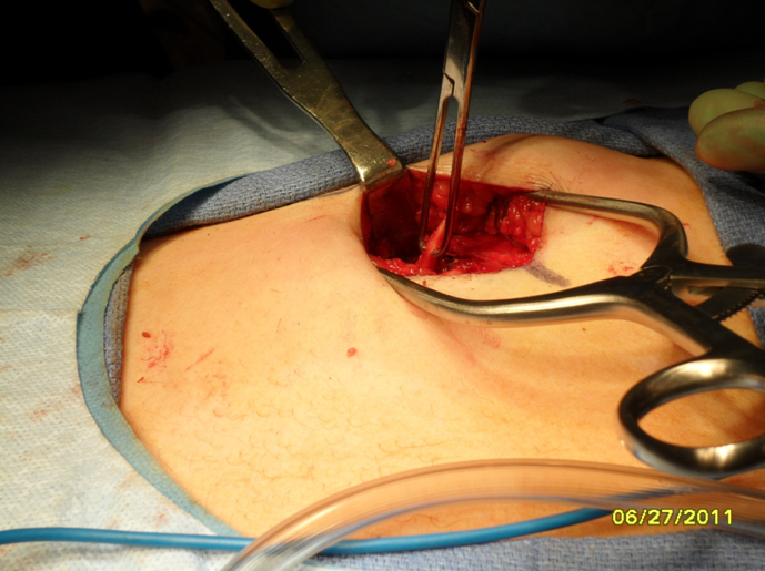 Figure 8 Vertical incisions between the costochondral junctions have been made and the cartilage is delivered from the wound.